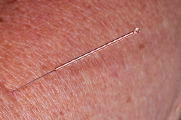 Image showing acupuncture 