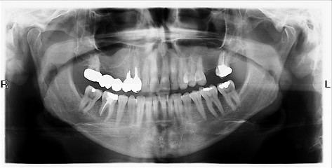 Image showing Teeth on X-Ray Image