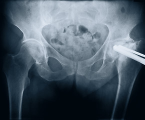 Image showing x-ray with bolt