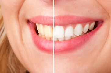 Image showing Dental Whitening