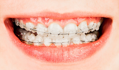 Image showing Braces