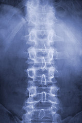 Image showing Spine on x-ray