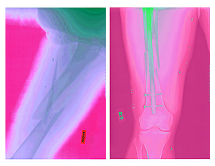 Image showing Real X-rays of Femur Fracture-Before and After