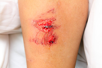 Image showing wound