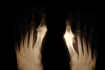 Image showing x-ray of foots 