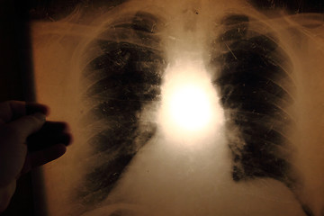 Image showing x-ray of lungs