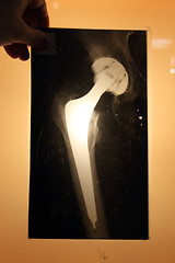 Image showing x-ray of hip endoprosthese