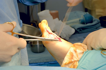 Image showing Foot Surgery - Bunionectomy - Suturing