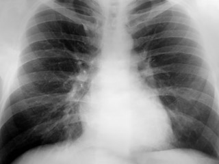 Image showing Xray Chest Positive