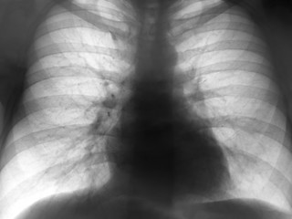 Image showing Xray Chest Negative