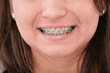 Image showing Close-up of a smiling young teenager with braces 