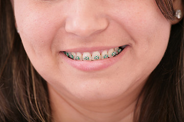 Image showing teeth with braces 