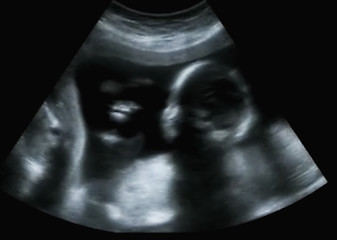 Image showing Obstetric Ultrasonography Ultrasound Echography of a first month