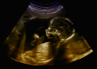 Image showing Obstetric Ultrasonography Ultrasound Echography of a first month