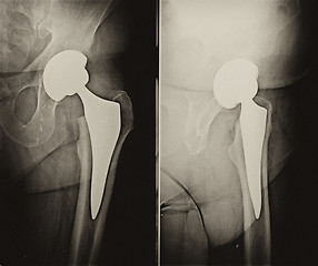 Image showing Radiography of operation of implantation of a prostheses in the 