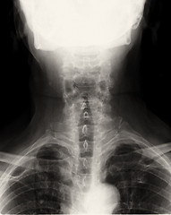 Image showing Spinal Column Back Upper Part xray