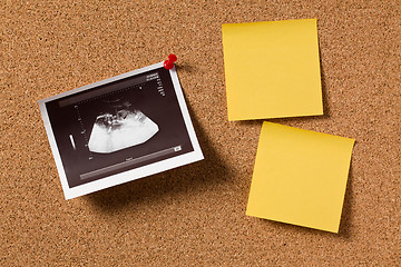 Image showing ultrasound photo on corkboard