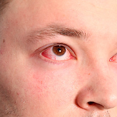 Image showing Man with conjunctivitis