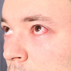 Image showing Man suffering from conjunctivitis