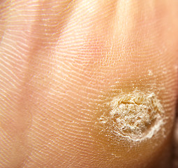 Image showing Callus under foot