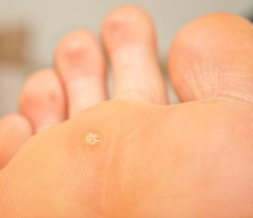 Image showing Callus under foot