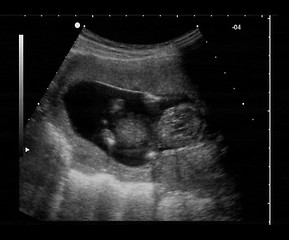 Image showing ultrasound fetus