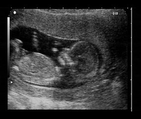 Image showing ultrasound fetus