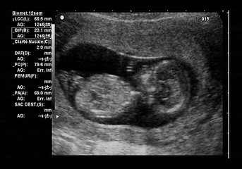 Image showing ultrasound fetus