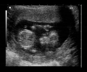 Image showing ultrasound fetus