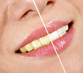 Image showing Whitening