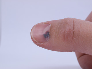 Image showing Subungual hematoma under nail