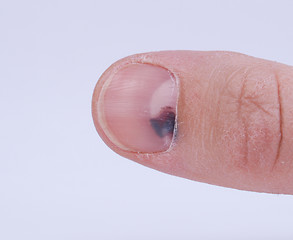 Image showing Subungual hematoma under nail