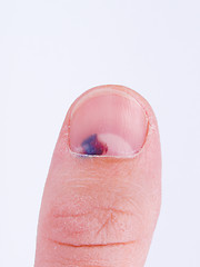 Image showing Subungual hematoma under nail