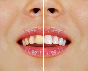 Image showing teeth before and after whitening
