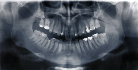 Image showing Details of black white X-ray scan of human teeth