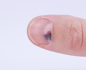 Image showing Subungual hematoma under nail