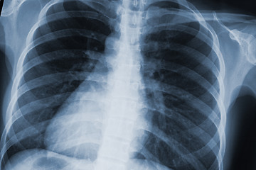 Image showing chest xray scan
