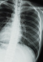 Image showing chest xray scan