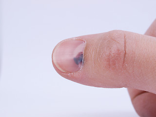 Image showing Subungual hematoma under nail