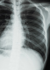 Image showing Chest xray scan