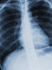 Image showing Chest xray scan