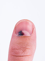 Image showing Subungual hematoma under nail