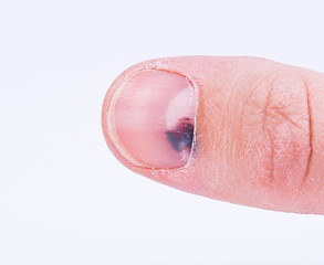 Image showing Subungual hematoma under nail