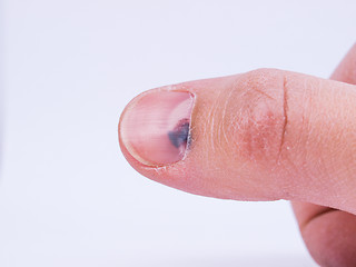 Image showing Subungual hematoma under nail