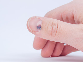 Image showing Subungual hematoma under nail