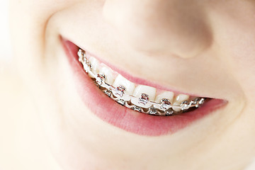 Image showing Smile with braces