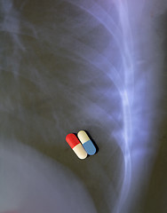 Image showing Lung infection combined therapy