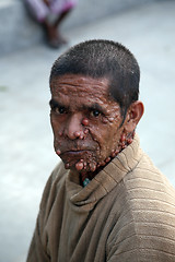 Image showing Streets of Kolkata. Portrait of sick man