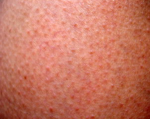 Image showing Sunburn