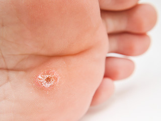 Image showing Callus under foot